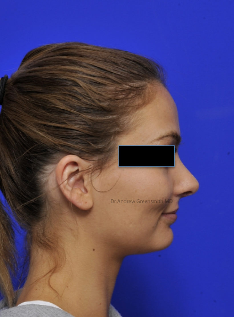 After Procedure
